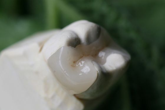 上張りおよび象眼細工審美的な人工的なEMAXの歯科王冠