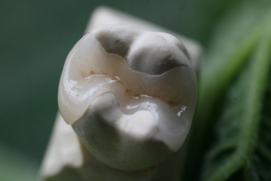 固定補綴の永久的な解決EMAXの歯科王冠