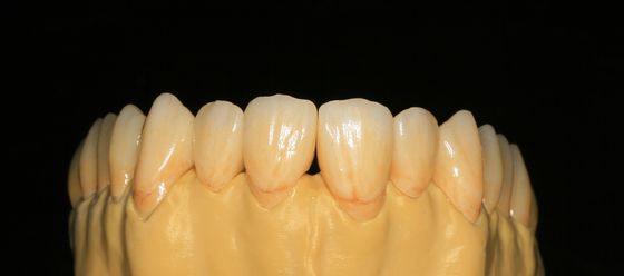 歯科実験室は補綴を層にした前歯のためのジルコニアの歯科王冠を固定した