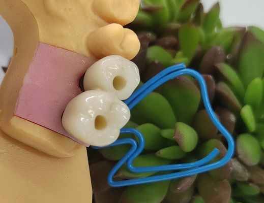 Endosseousの歯科インプラントは戴冠する