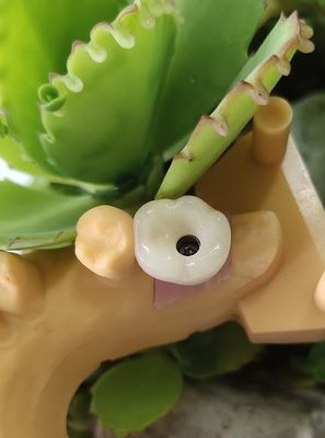 解決のノーベル セメントで接合されていたBIOCARE歯科インプラントは戴冠する