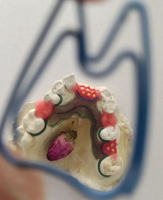 Cr Coの部分的な総義歯の金属フレームワーク