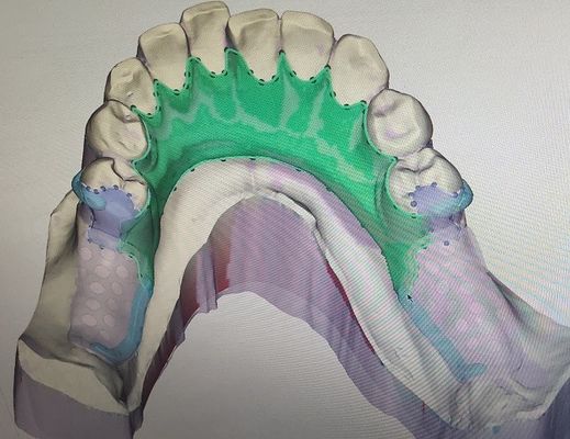 取り外し可能な3Dは部分的な総義歯の金属フレームワークを印刷した