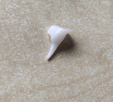 EMAXの磁器歯科Pinの中心の補強