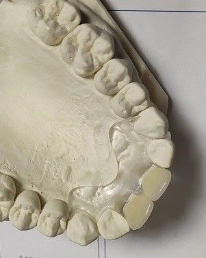 快適な適合ISO13485 RPDの柔らかく見えない総義歯