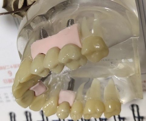 100% Biocompatibility PMMAの仮の王冠