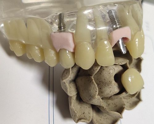 PFMの内部の王冠の歯科3D印刷物を製粉する金属のブランク