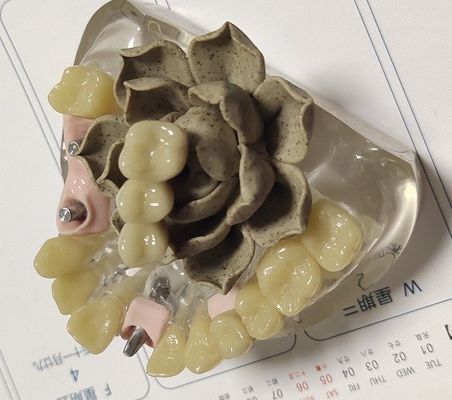 100% Biocompatibility PMMAの仮の王冠