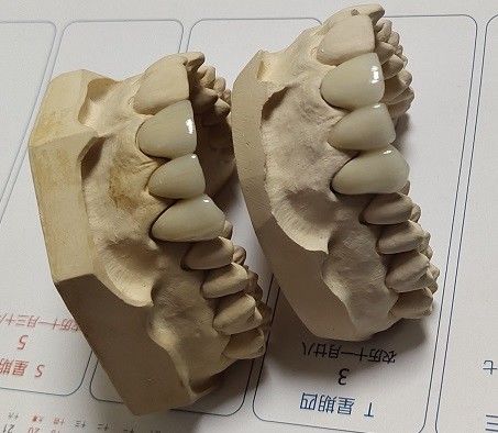 磁器CAD CAM PFMの王冠
