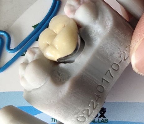 歯科実験室プロダクトCAD CAM PFM王冠の磁器は金属をかぶせるために溶けた
