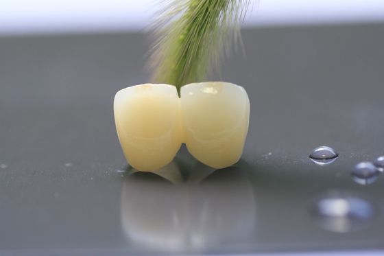 3D印刷物フレームワークPFM歯科医療のための歯科実験室の王冠