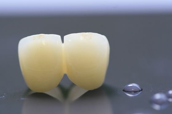 3D印刷物フレームワークPFM歯科医療のための歯科実験室の王冠