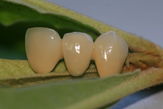 ISO13485よいBiocompatibility PFMの非貴重な歯科王冠