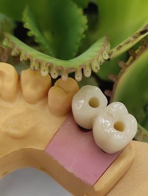 解決のノーベル セメントで接合されていたBIOCARE歯科インプラントは戴冠する