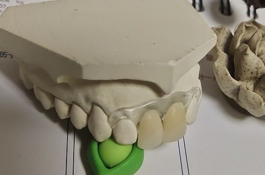 Valplastの一時的で柔らかく、伸縮性がある見えない総義歯