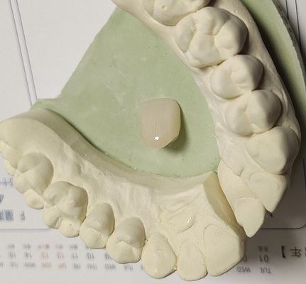 前方の歯のための樹脂の自然な色の合成の一時的な王冠