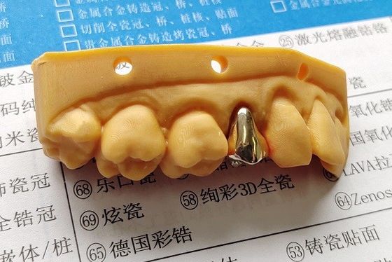 高く気高い金の完全な金属の歯科王冠
