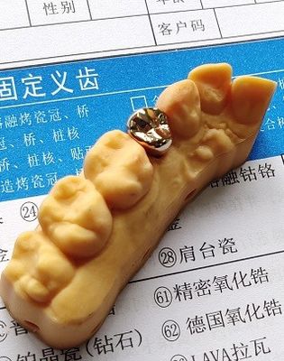 よい適性の高く貴重な金合金の歯科王冠